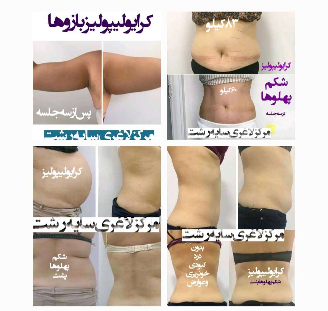 کلینیک لاغری تضمینی سایه کاهش سایز سریع در رشت